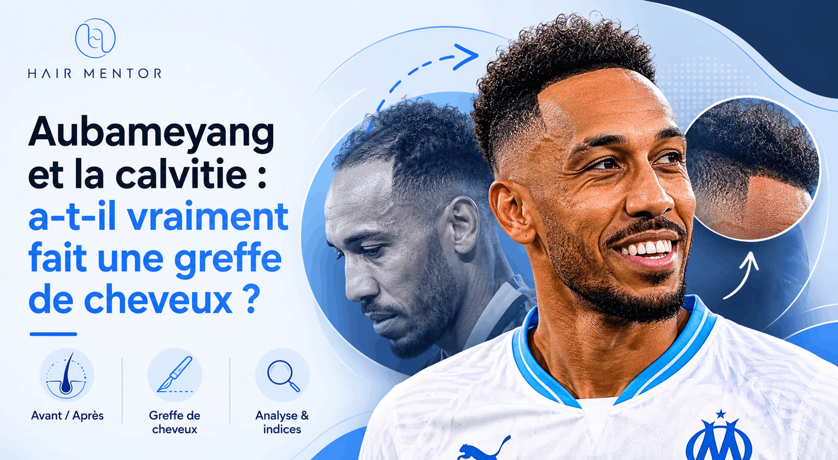 Aubamayeng et la calvitie
