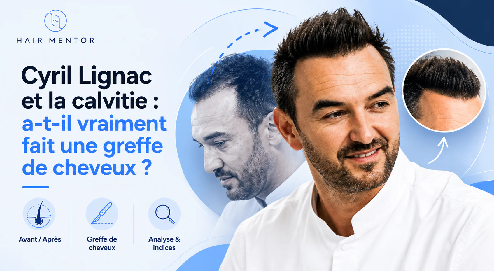 Cyril Lignac et la greffe de cheveux