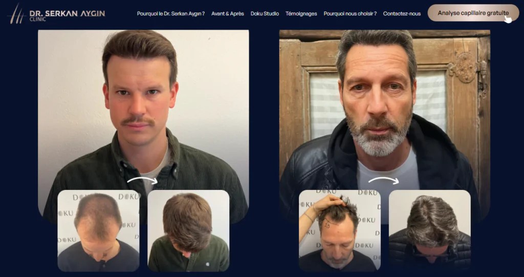 Meilleure clinique de greffe de cheveux à Istanbul : Dr Serkan Aygin
