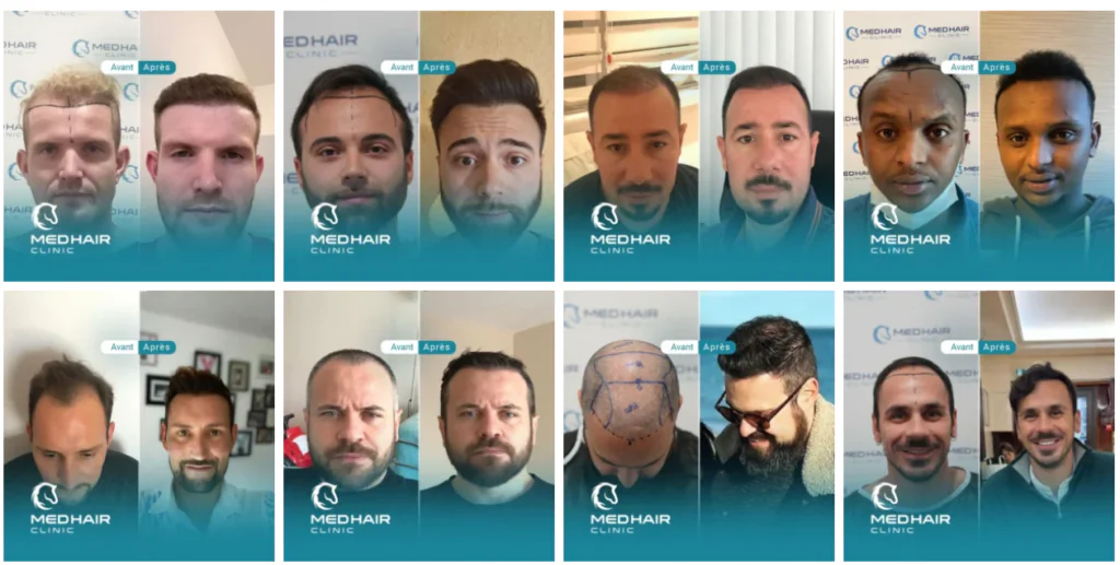 Meilleure clinique de greffe de cheveux à Istanbul : MedHair Clinic