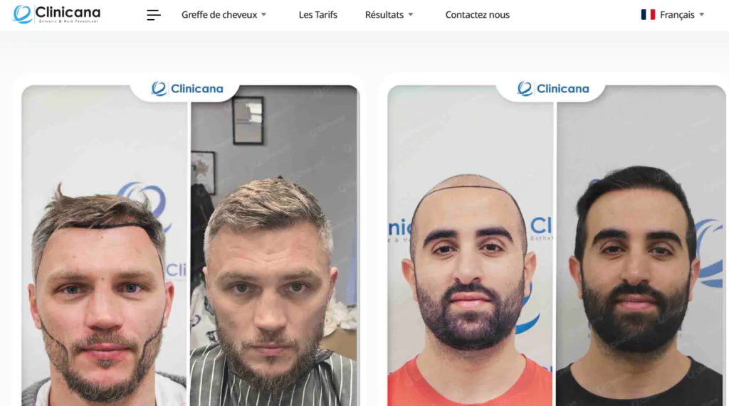 Meilleure clinique de greffe de cheveux à Istanbul : Clinicana