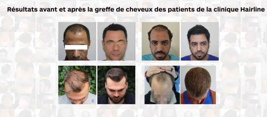 Meilleure clinique de greffe de cheveux en Turquie :  HLC Hairline Clinic 
