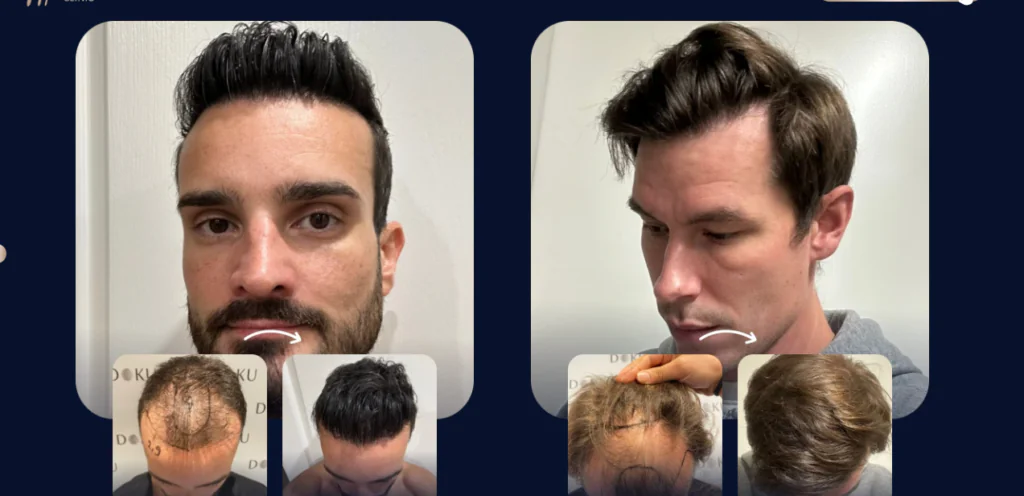 Meilleure clinique de greffe de cheveux en Turquie :  Dr Serkan Aygin Clinic