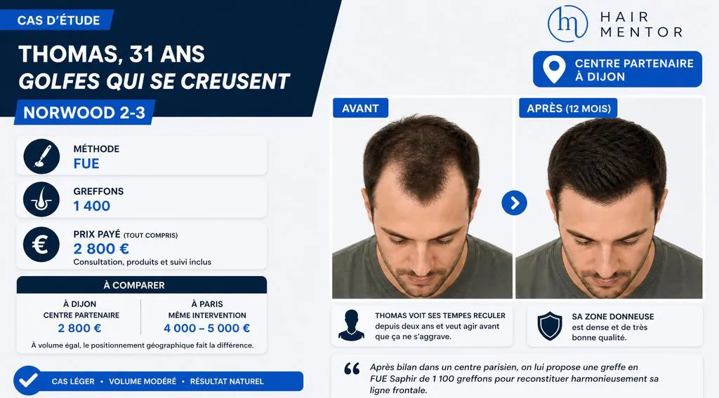 Cas n°1 greffe capilaire à dijon :   Thomas, 31 ans, golfes qui se creusent (Norwood 2-3)