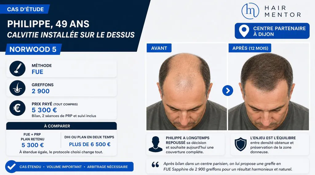 Cas n°2 greffe capilaire a dijon :   Philippe, 49 ans, calvitie installée sur le dessus (Norwood 5)