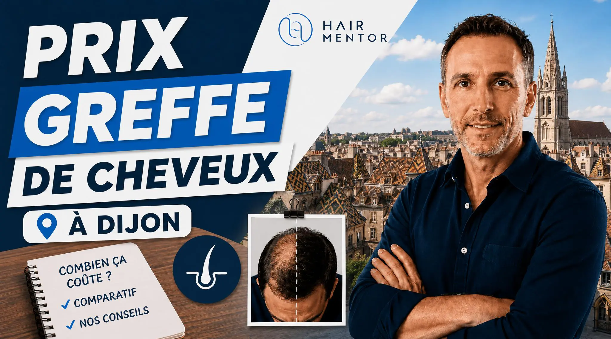 Combien coûte une greffe de cheveux à Dijon en 2026 ?