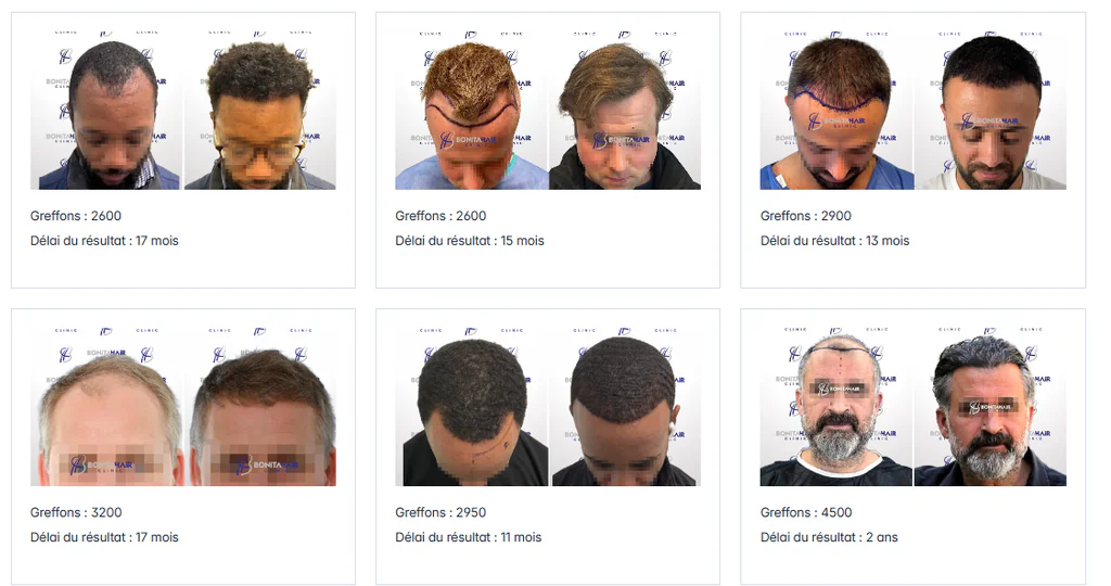 Meilleure clinique de greffe de cheveux à Bruxelles :  Cas avant/après de la clinique Bonita Hair Clinic