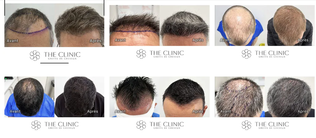 Meilleure clinique de greffe de cheveux à Bruxelles :  Cas avant/après de The Clinic