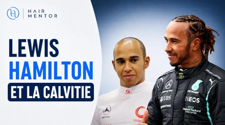 lewis-hamilton-calvitie