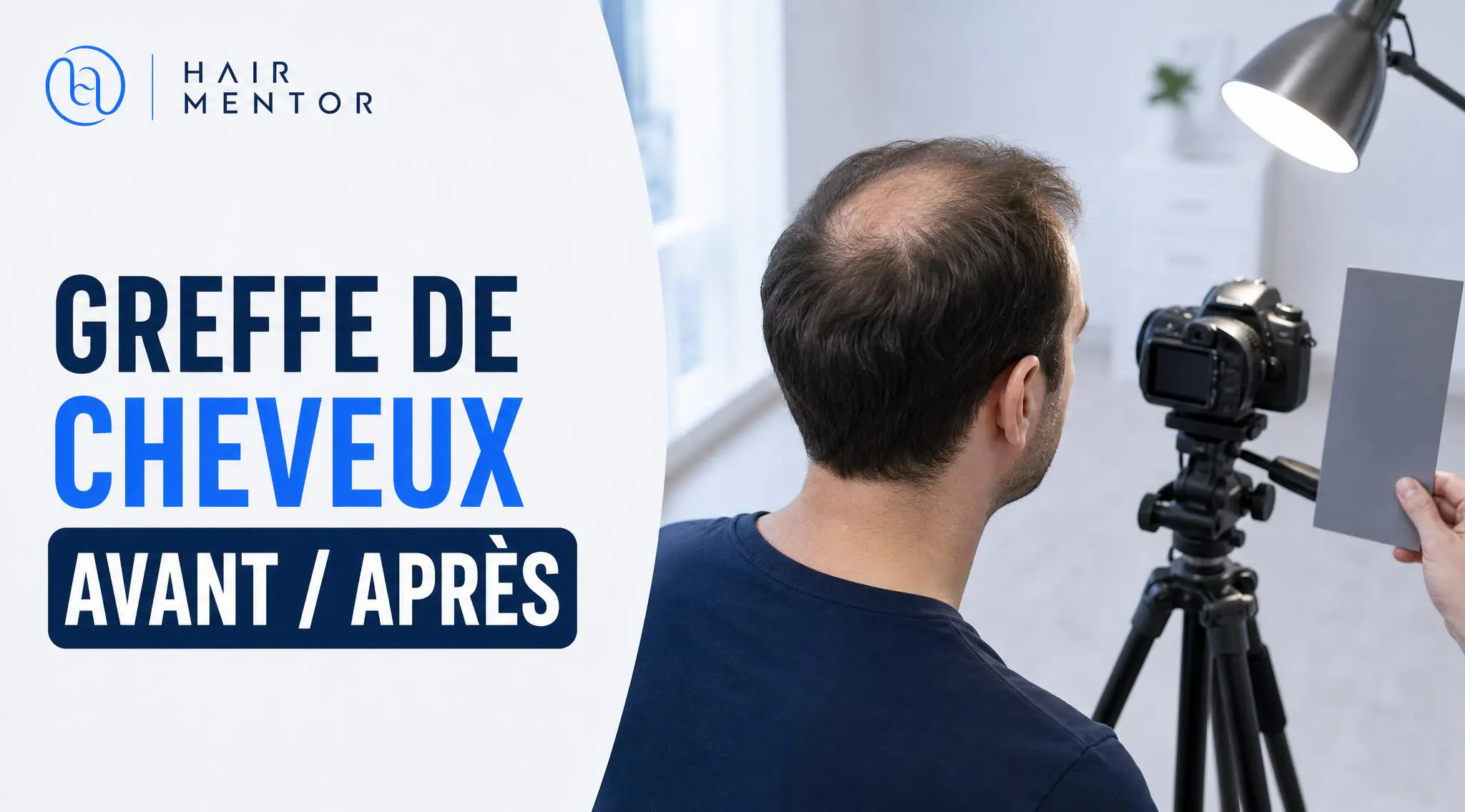 Greffe de cheveux avant après