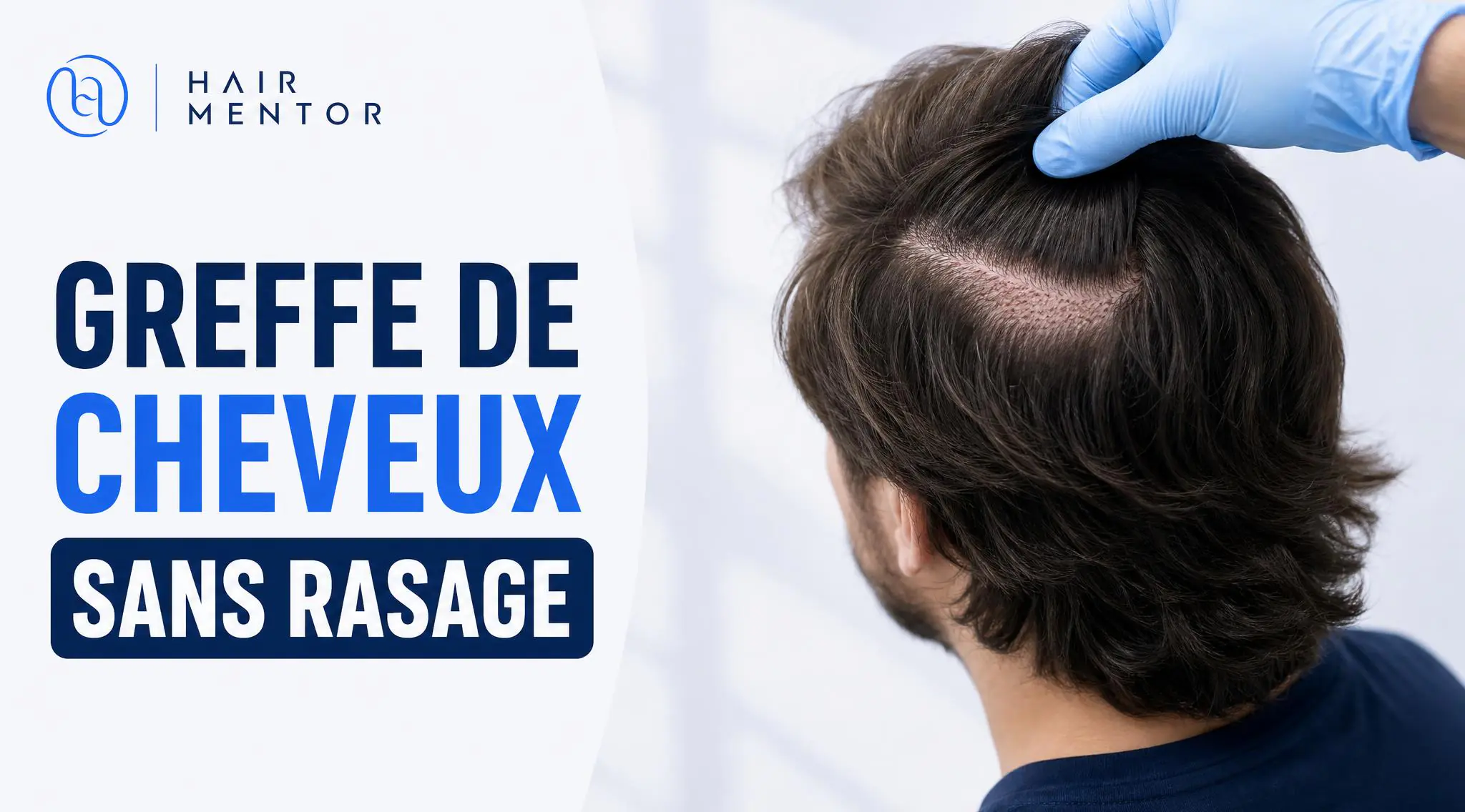 Greffe de cheveux sans rasage