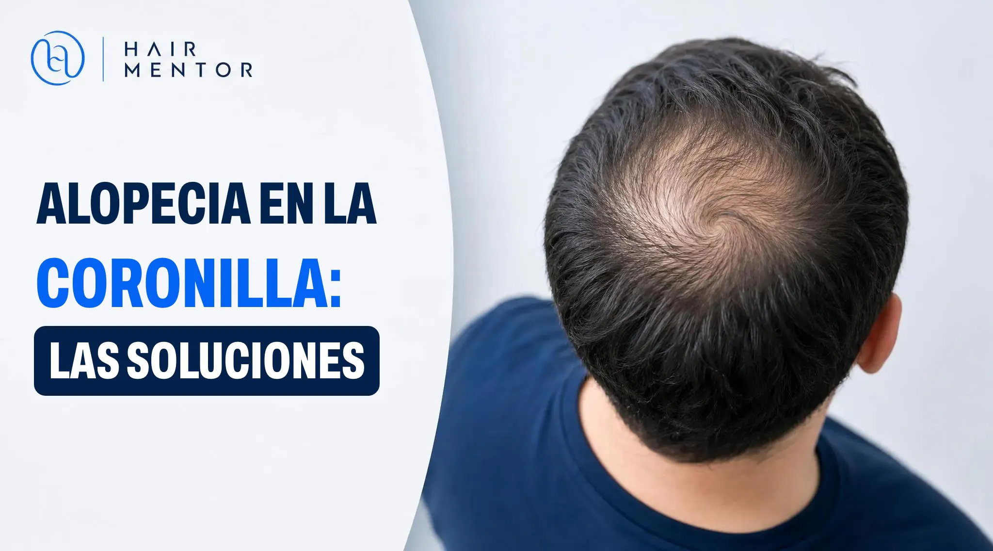 Alopecia en la coronilla
