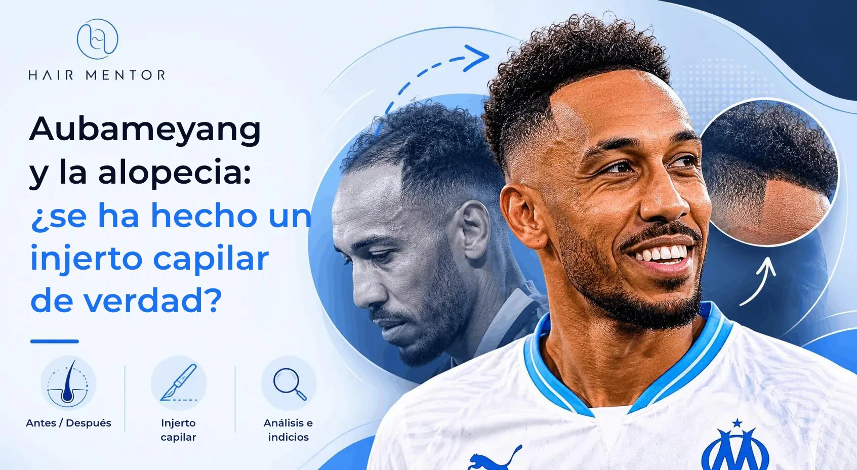 Aubameyang y la alopecia
