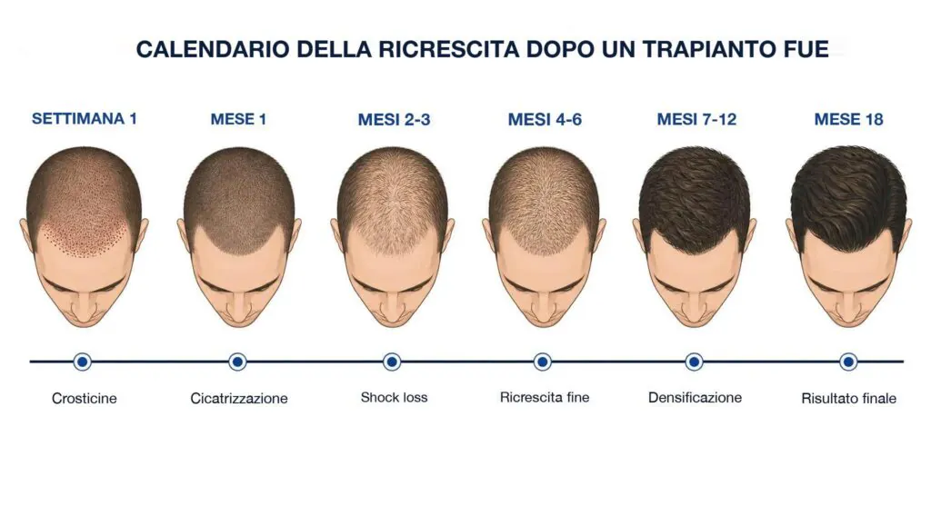 Calendario della ricrescita dopo un trapianto FUE