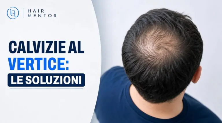 Nuca di un uomo con il vertice chiaramente diradato