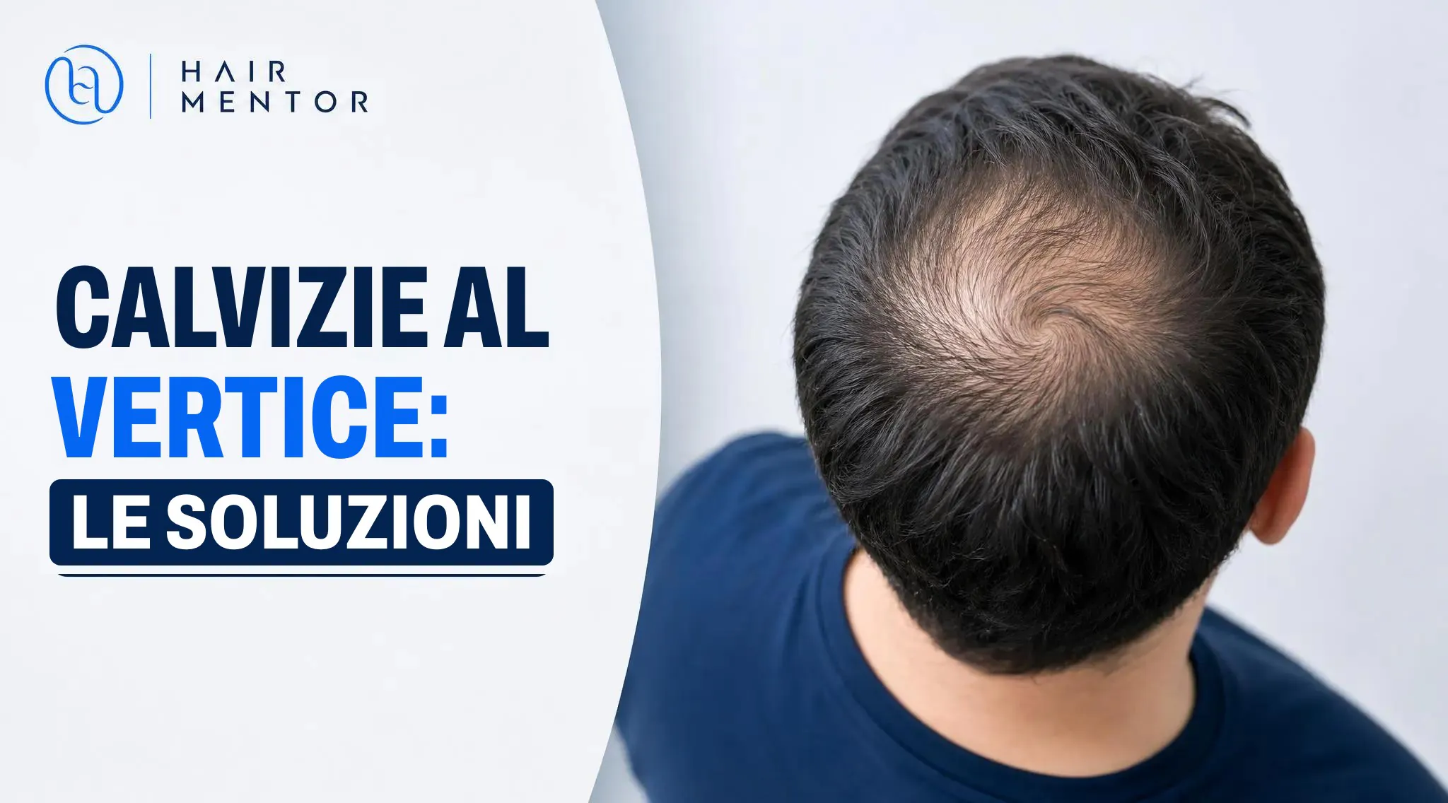 Nuca di un uomo con il vertice chiaramente diradato