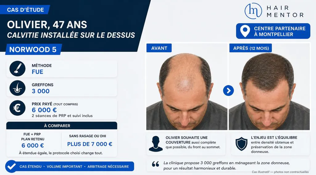 Cas d'étude d'Olivier, 47 ans, greffe de 3 000 greffons à Montpellier sur une calvitie Norwood 5