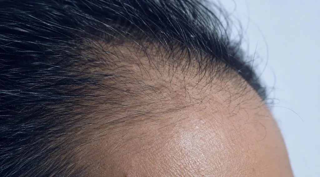 Macro d'une ligne frontale aux cheveux d'épaisseurs inégales, illustrant la miniaturisation que la clascotérone cherche à freiner