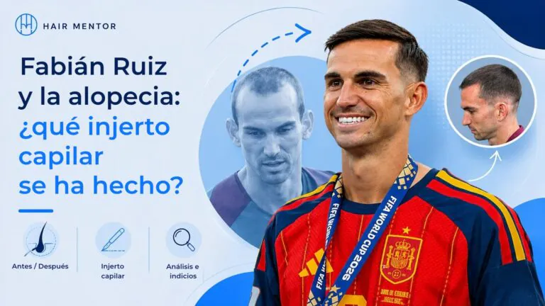 Fabián Ruiz y la alopecia