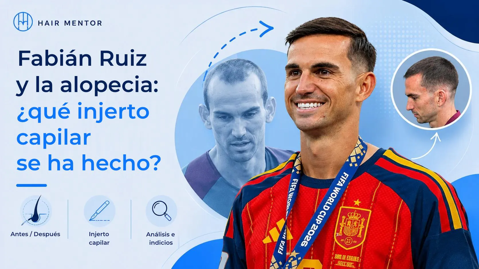 Fabián Ruiz y la alopecia