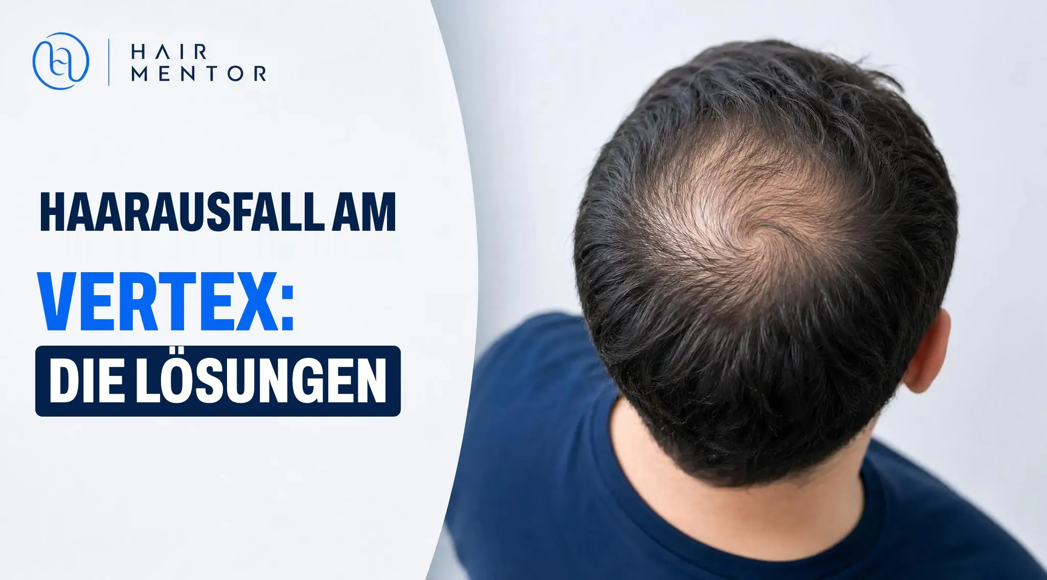 Haarausfall am Vertex