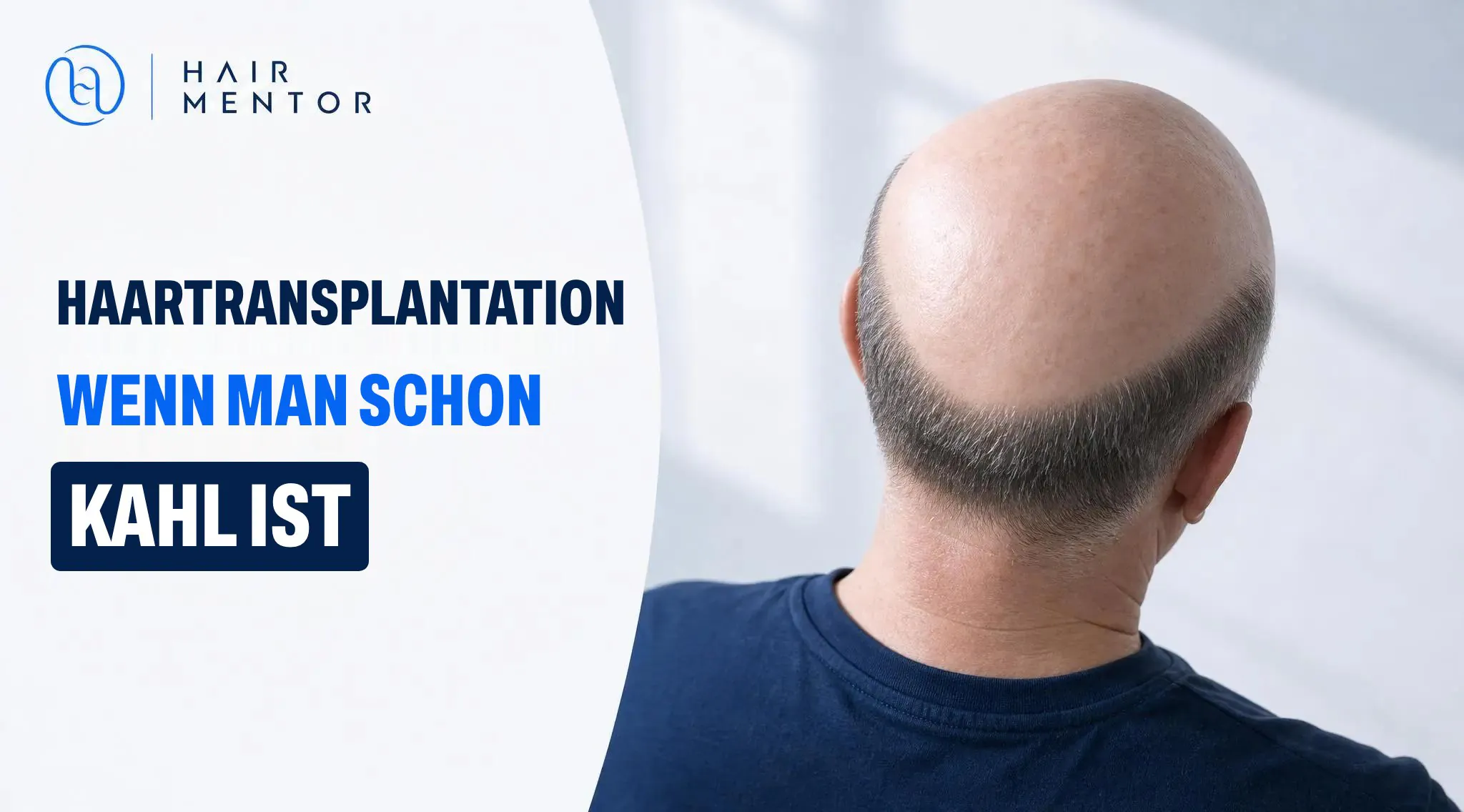 Haartransplantation bei fortgeschrittener Glatze