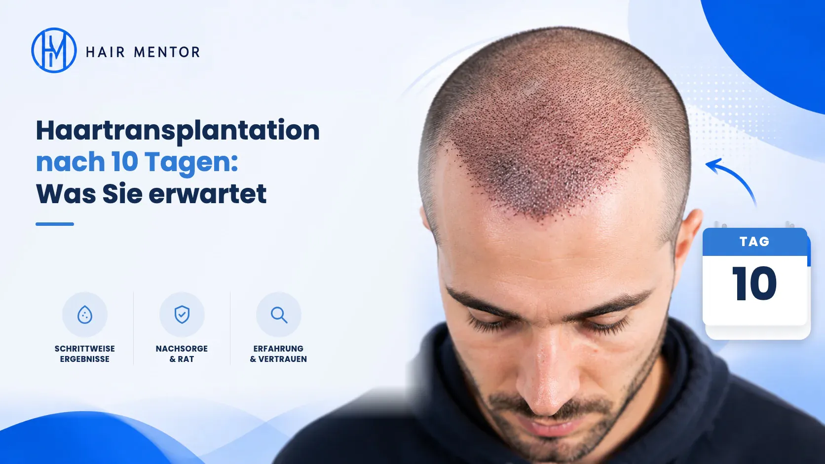 Haartransplantation zehn Tage danach
