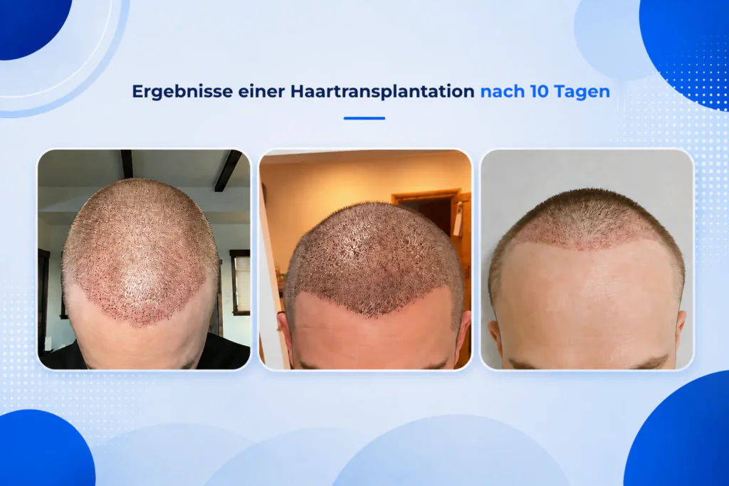 Ergebnisse einer Haartransplantation nach 10 Tagen