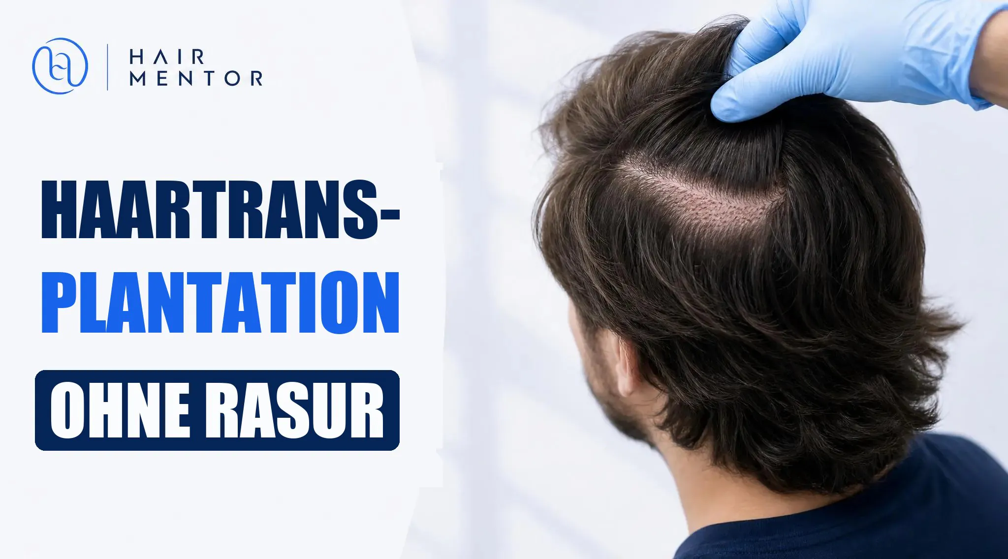 Haartransplantation ohne Rasur: langes Haar direkt nach dem Eingriff erhalten