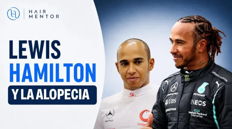 Lewis Hamilton y la alopecia