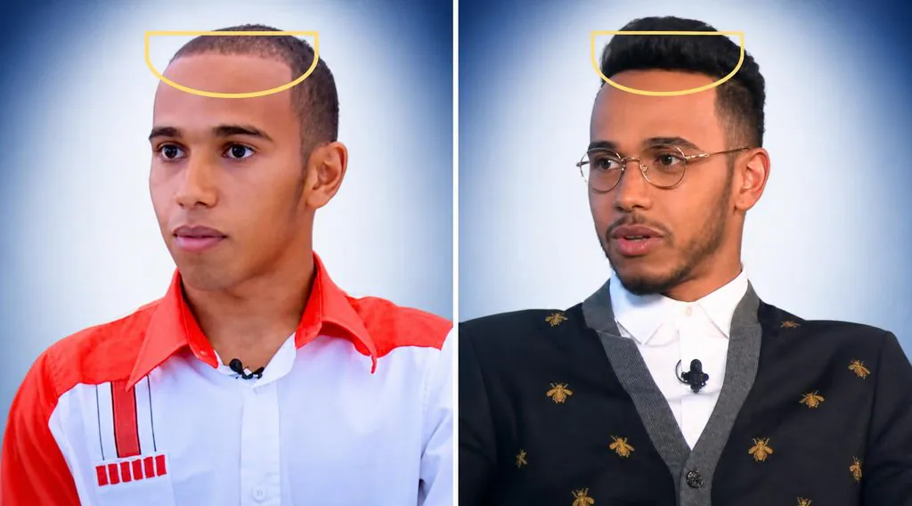 Lewis Hamilton a-t-il fait une greffe de cheveux ?