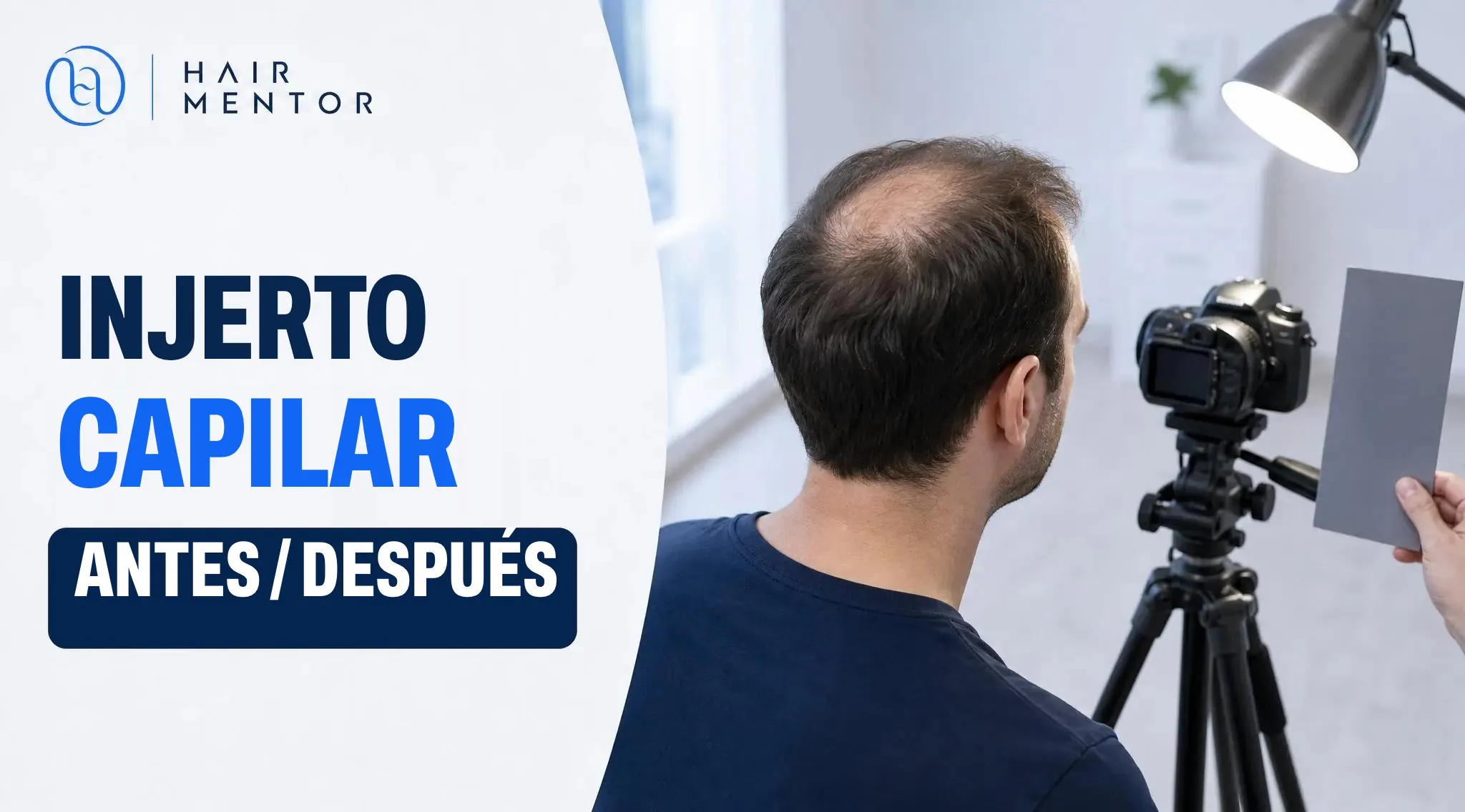 Injerto capilar antes y después