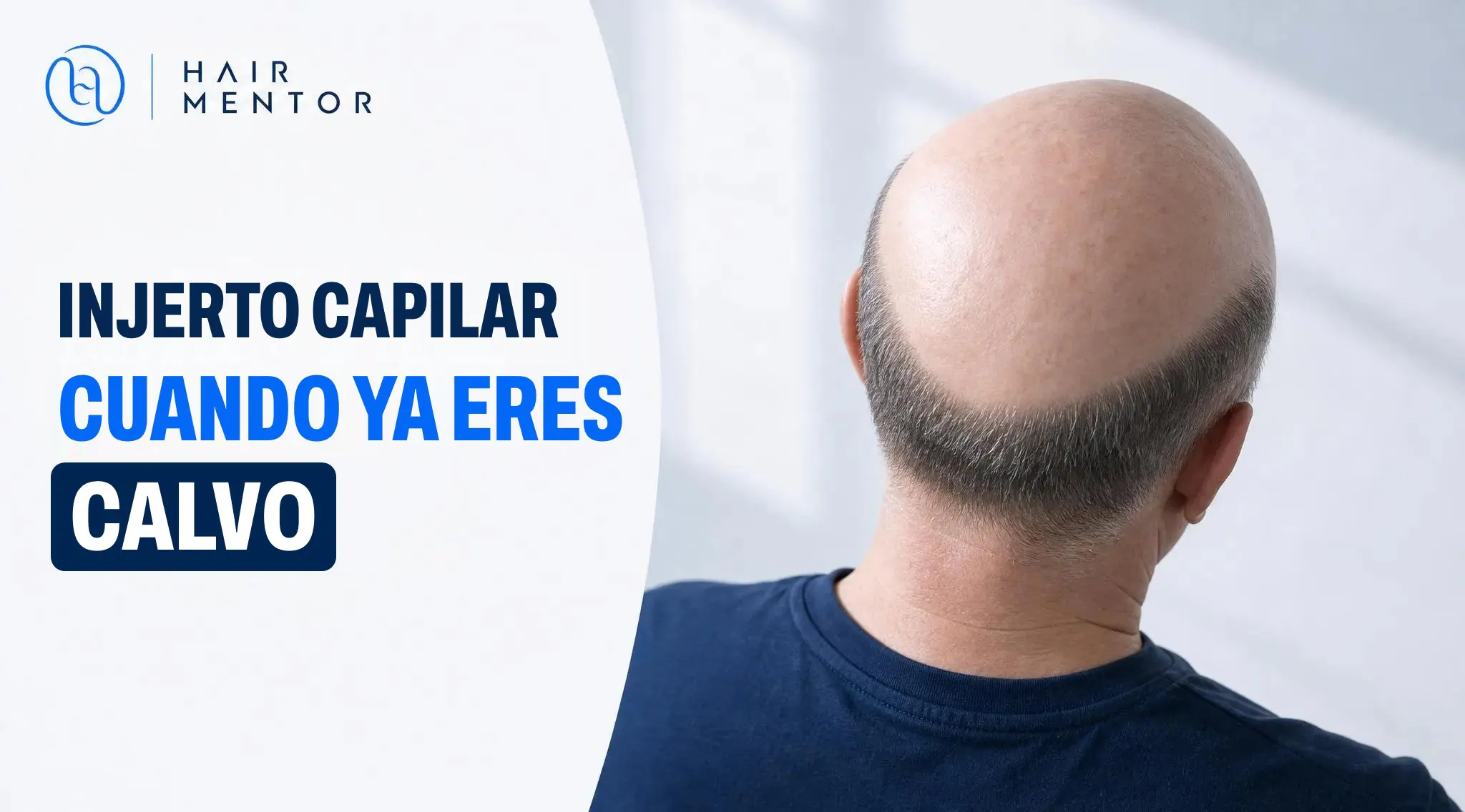Injerto capilar cuando ya eres calvo