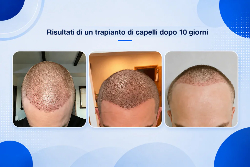 Esempi di trapianto di capelli dopo 10 giorni