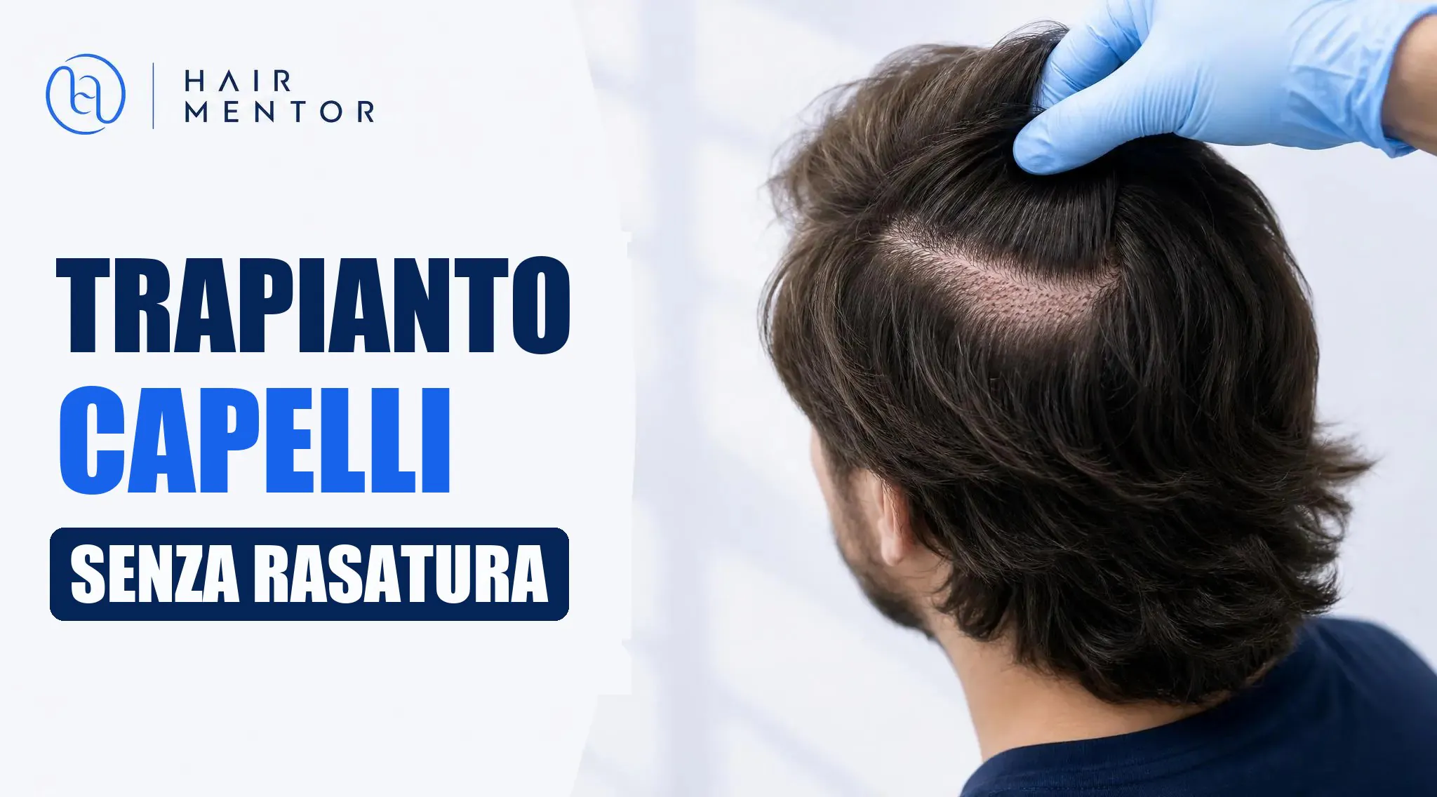 Trapianto di capelli senza rasatura: capelli lunghi conservati dopo l intervento
